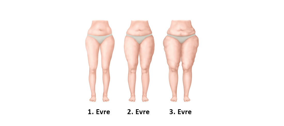 Lipödem Evreleri